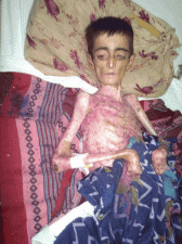 Mystery disease transforms young boy in Saudi into a skeleton