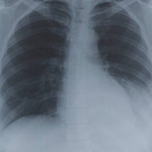 Expat asked to leave UAE due to old TB scars